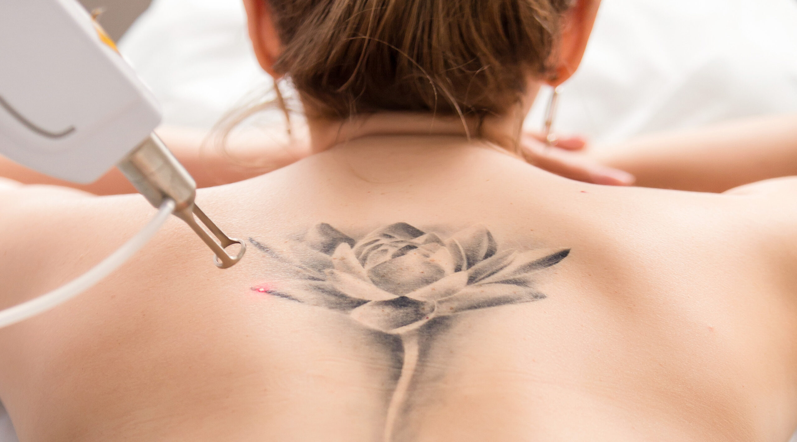 Does Laser Tattoo Removal Completely Remove the Tattoo?