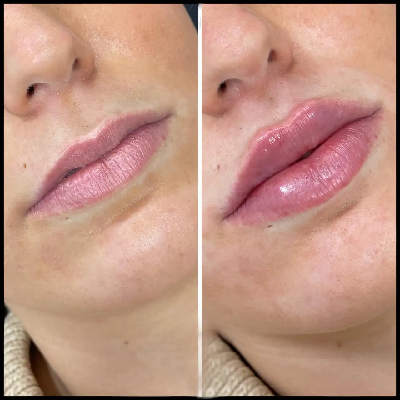 Juvederm Fillers