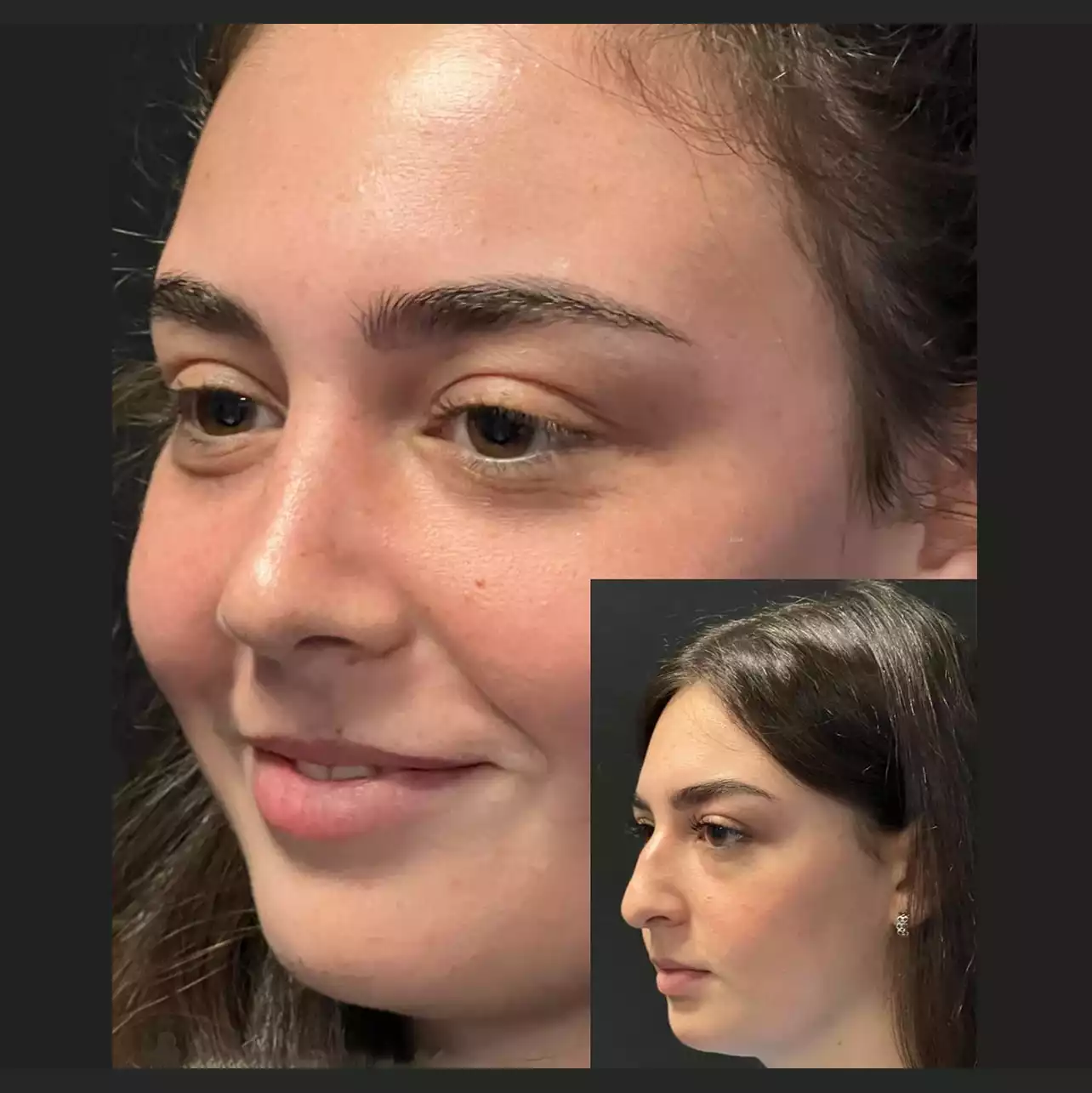 The Best Clinics for Nose Surgery in Dubai