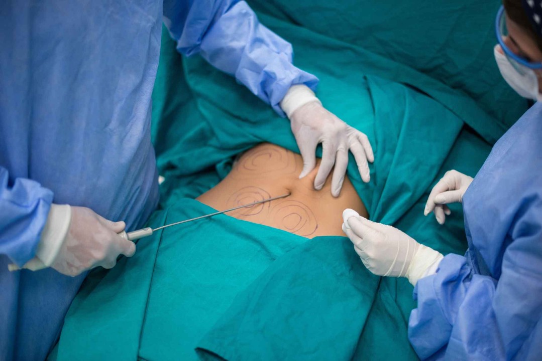 Liposuction in Dubai