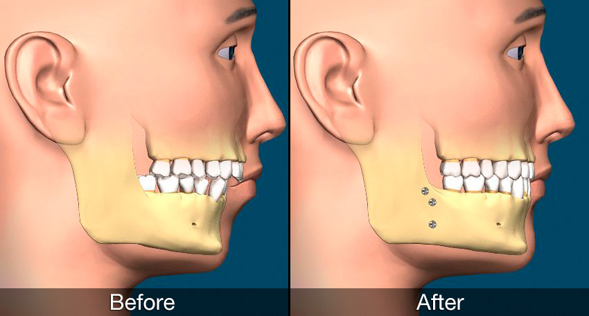 Corrective Jaw Surgery