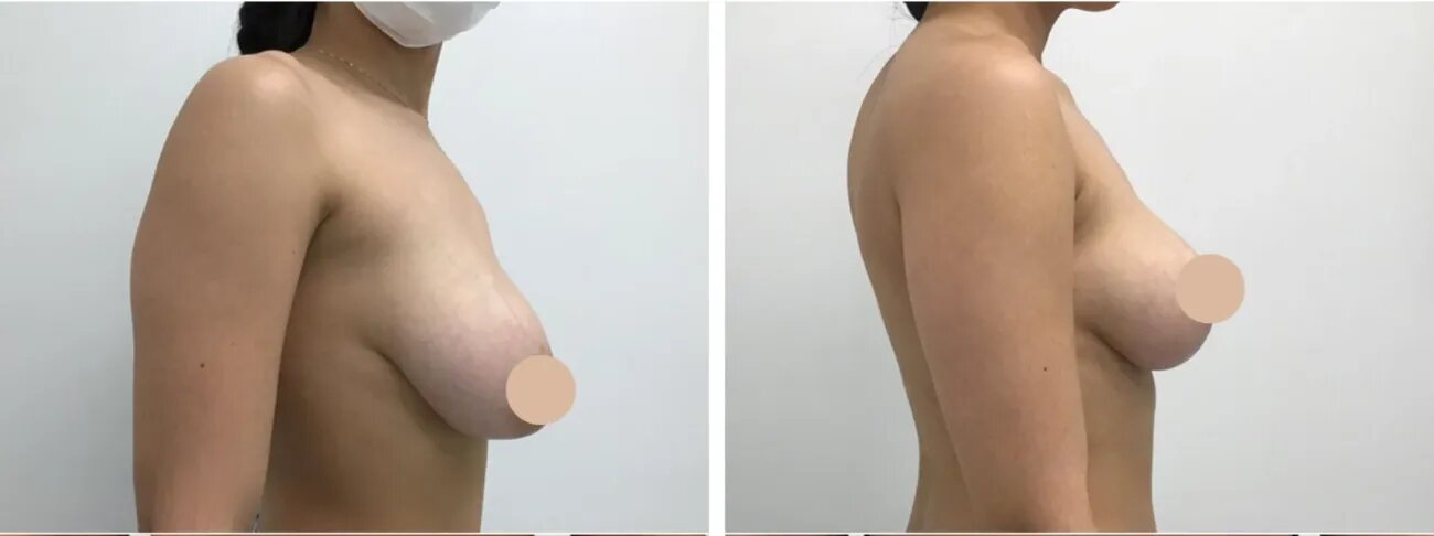 breast lift in dubai