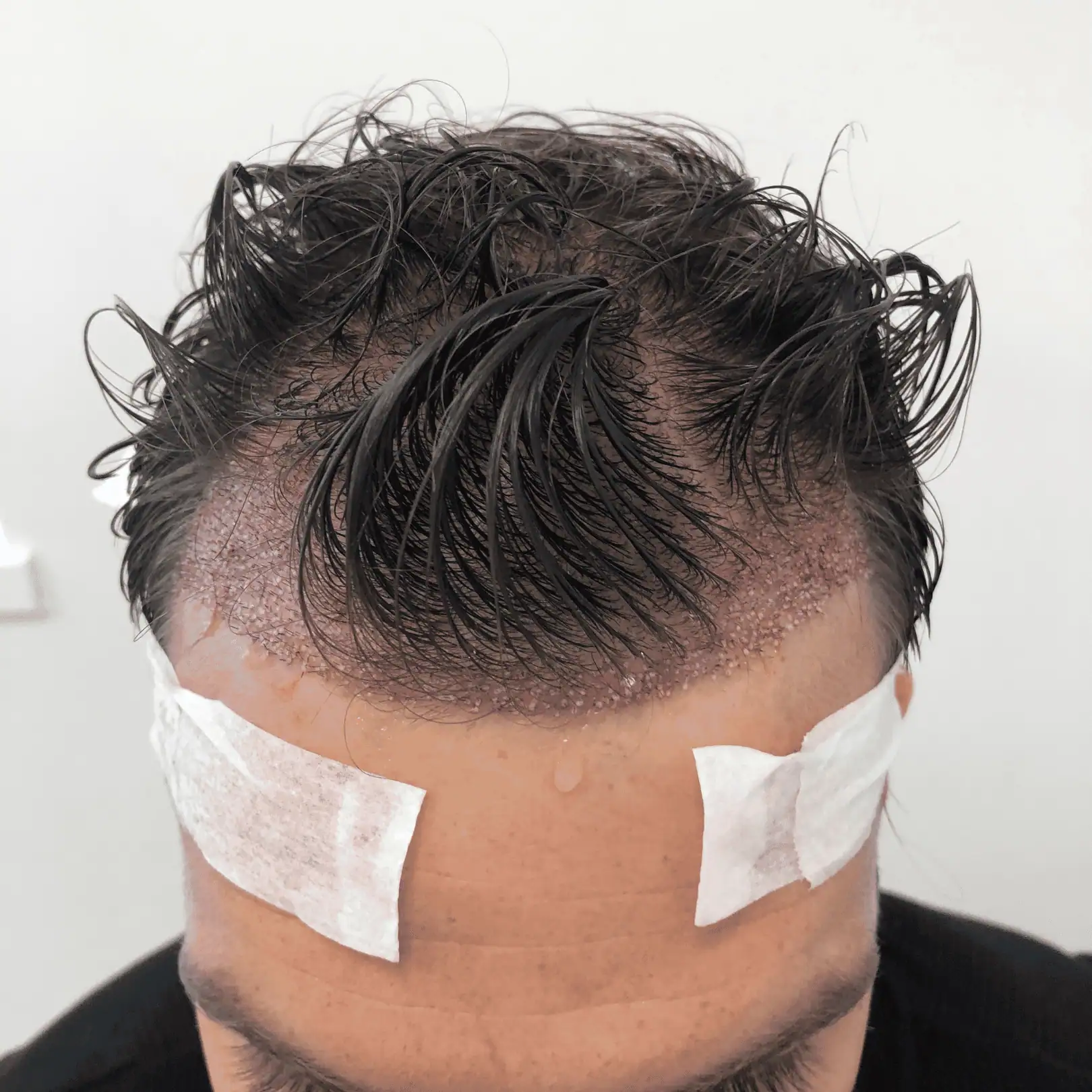Hair Transplant in Dubai